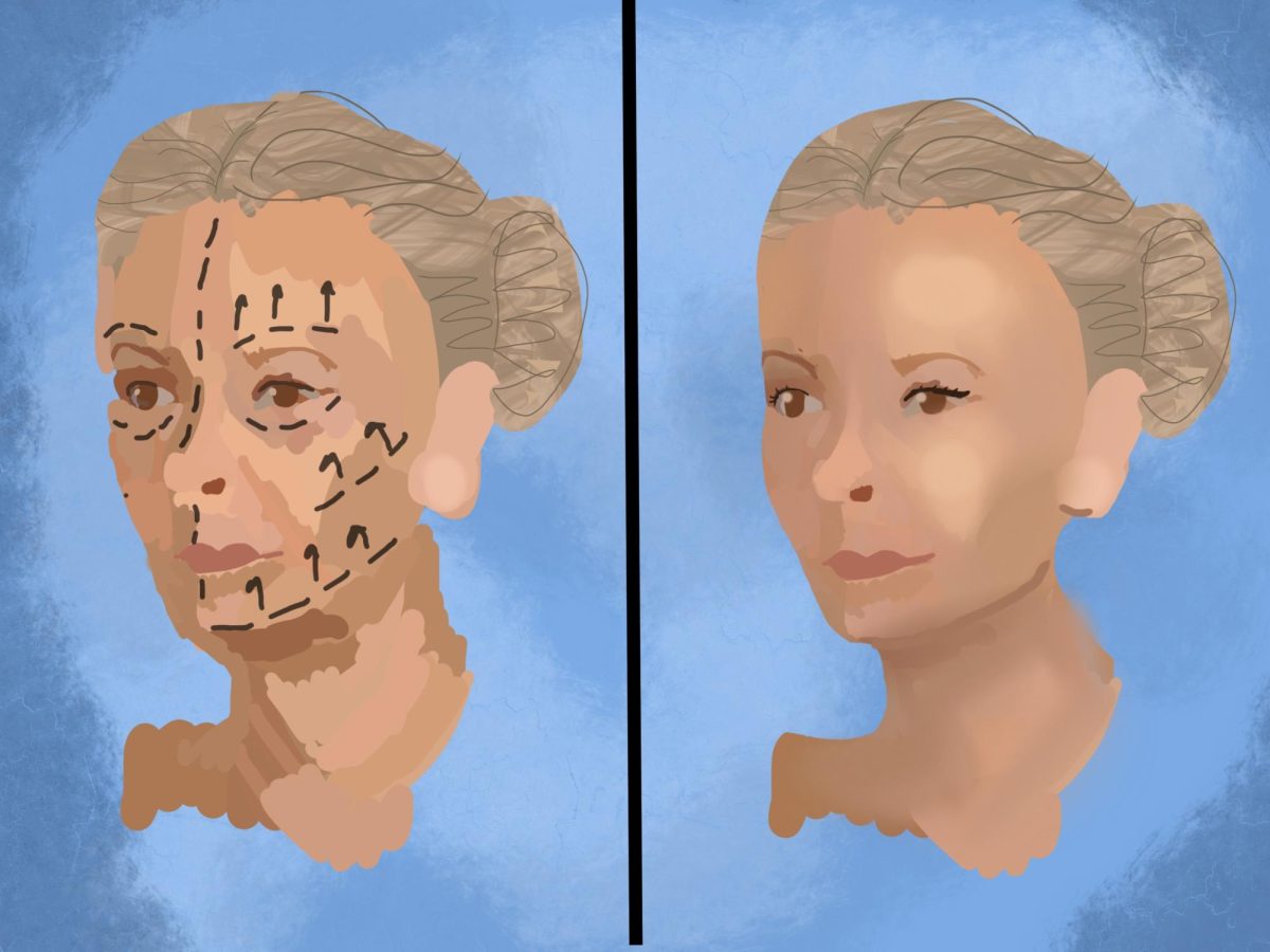 Illustration of the before and after of a facelift, a common type of plastic surgery in the United States.